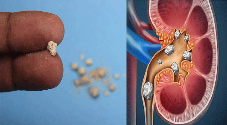 যেসব-খাবার-অতিরিক্ত-খেলে-কিডনিতে-পাথর-হয়,-প্রতিরোধের-উপায়